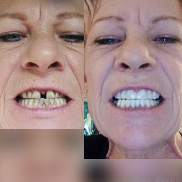 Veneera™ Veneers - 