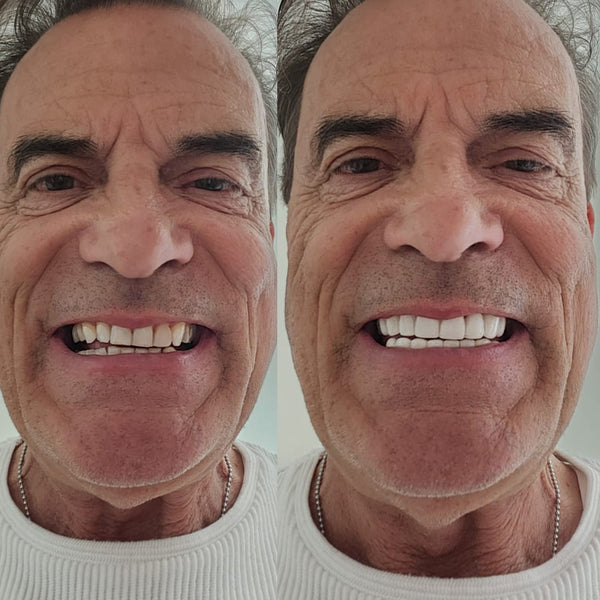 Veneera™ Veneers - 