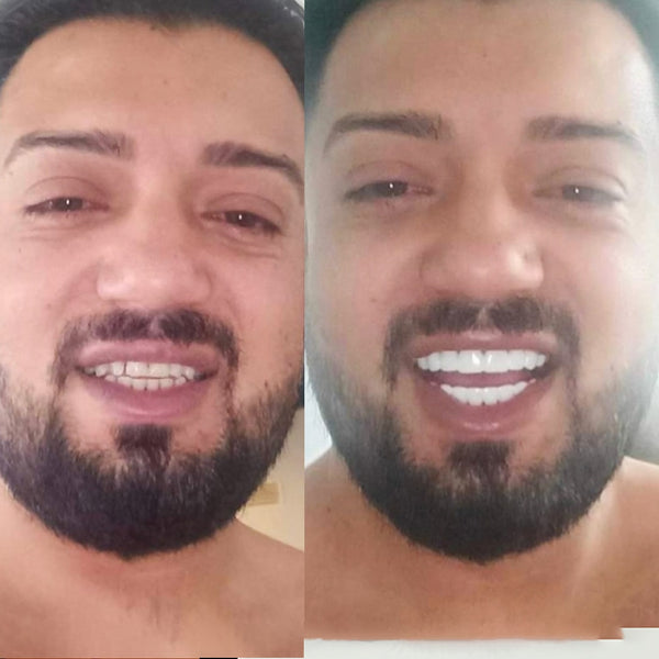 Veneera™ Veneers - 