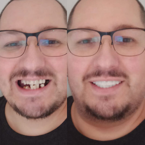 Veneera™ Veneers - 
